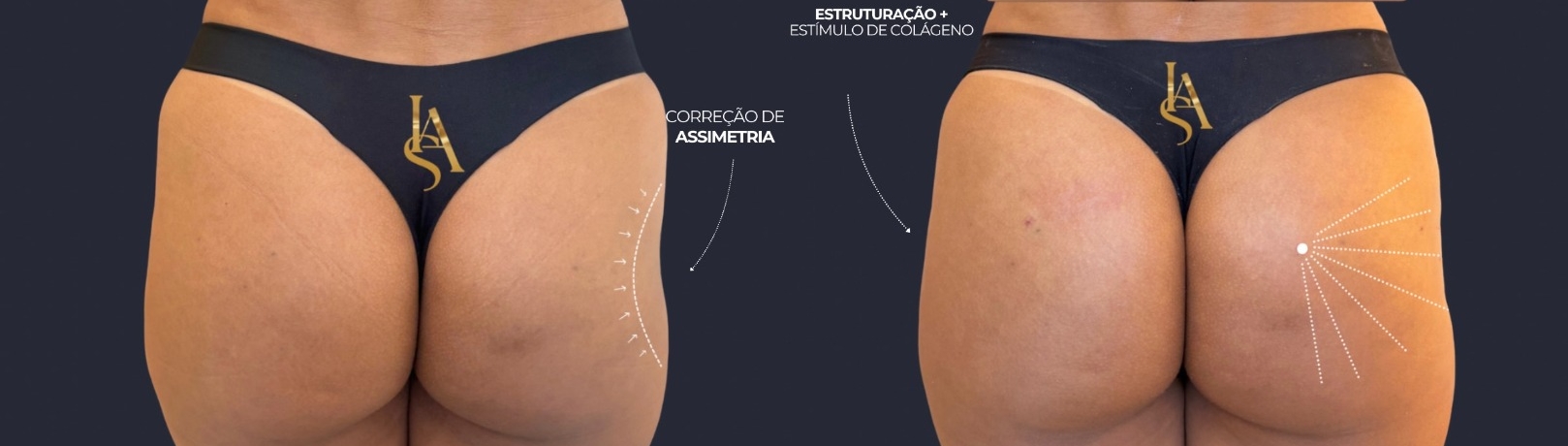 Bumbum Up Gold Antes e Depois