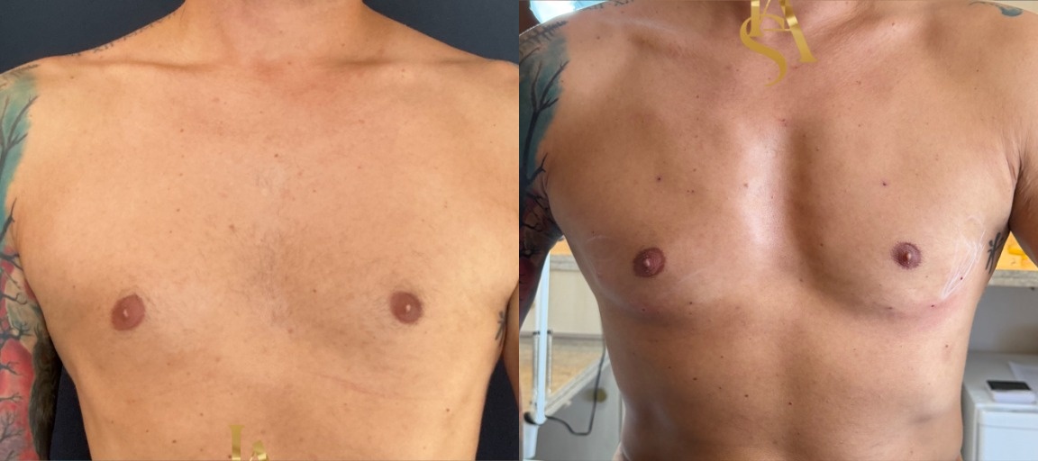 Harmonização Peitoral Antes e Depois