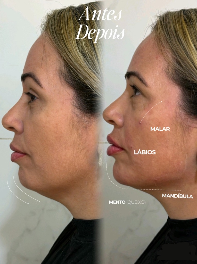 Antes e Depois Harmonização Facial